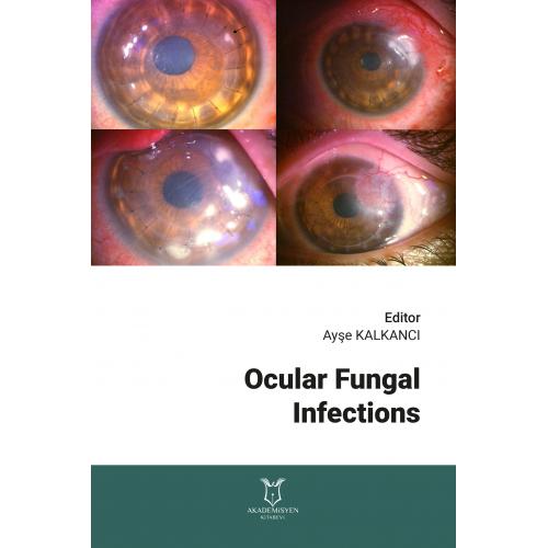 Ocular Fungal Infections Mehmet Semih Summak